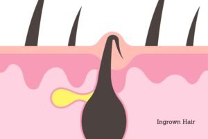 Ingrown Hair