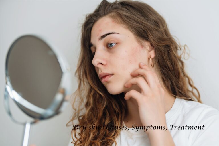 Dry skin featured image